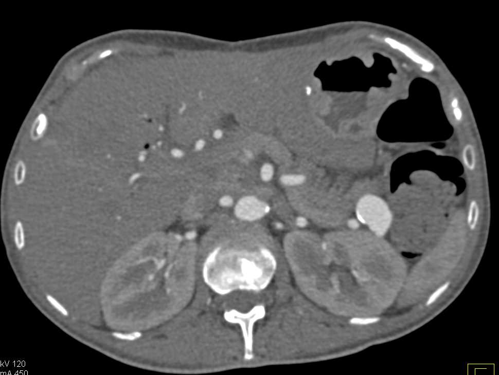 Splenic Artery Aneurysm - CTisus CT Scan