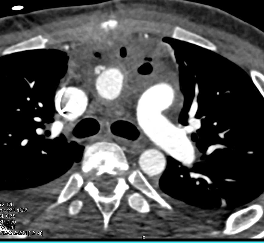 Mediastinal Changes Following Aortic Surgery - CTisus CT Scan