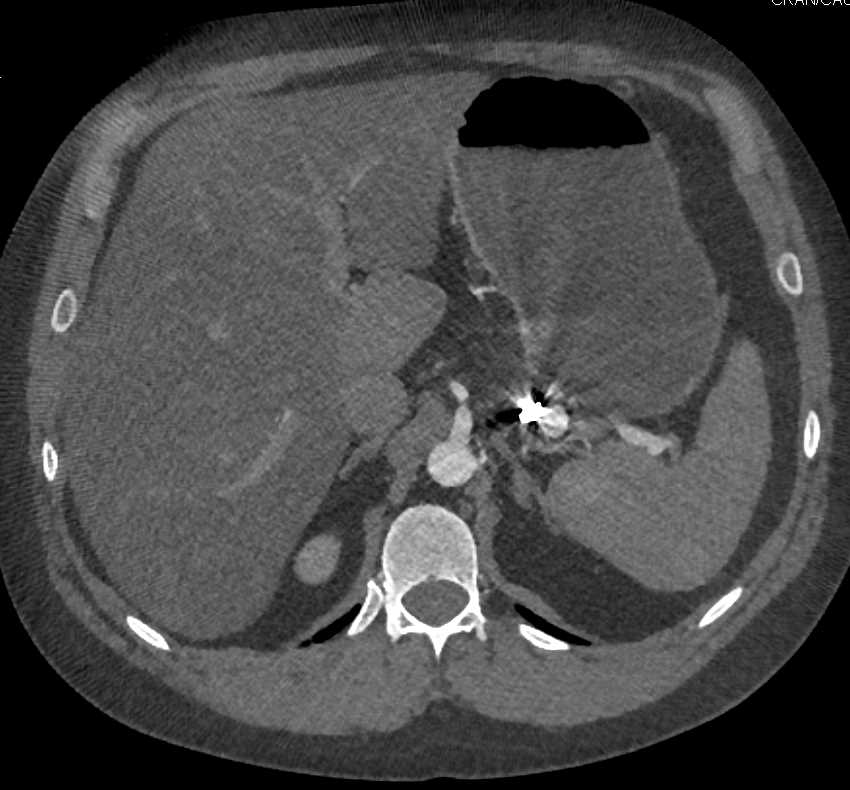 Fibromuscular Dysplasia Best Seen in the Right Renal Artery - CTisus CT Scan