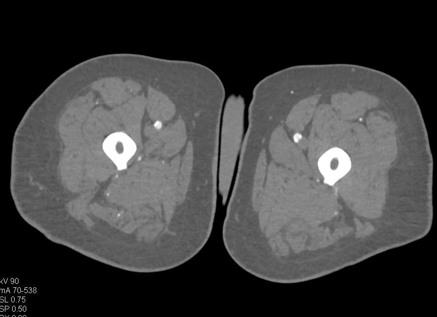 Significant Peripheral Vascular Disease (PVD) - CTisus CT Scan