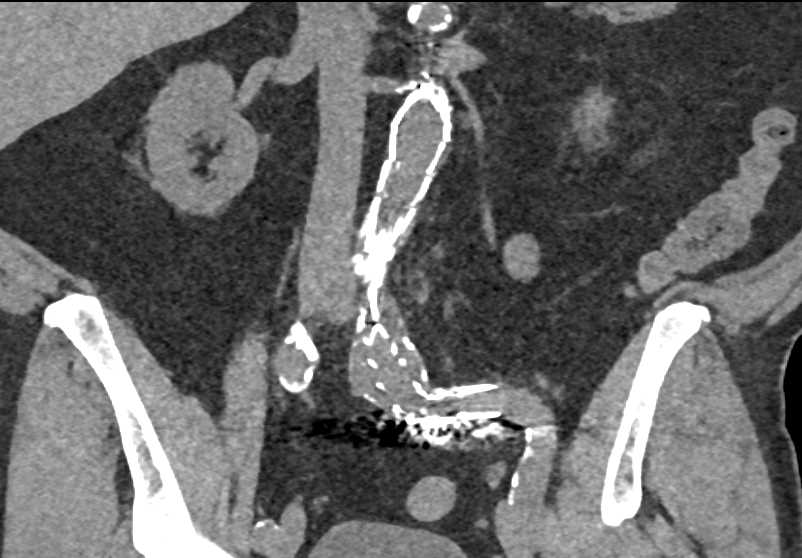 Failure of the Left Iliac Stent With Stent Angulation - CTisus CT Scan