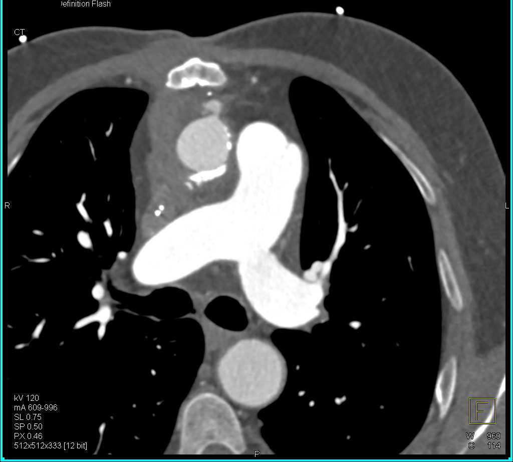 Pseudoaneurysm Ascending Aorta at the Trocar Site - CTisus CT Scan