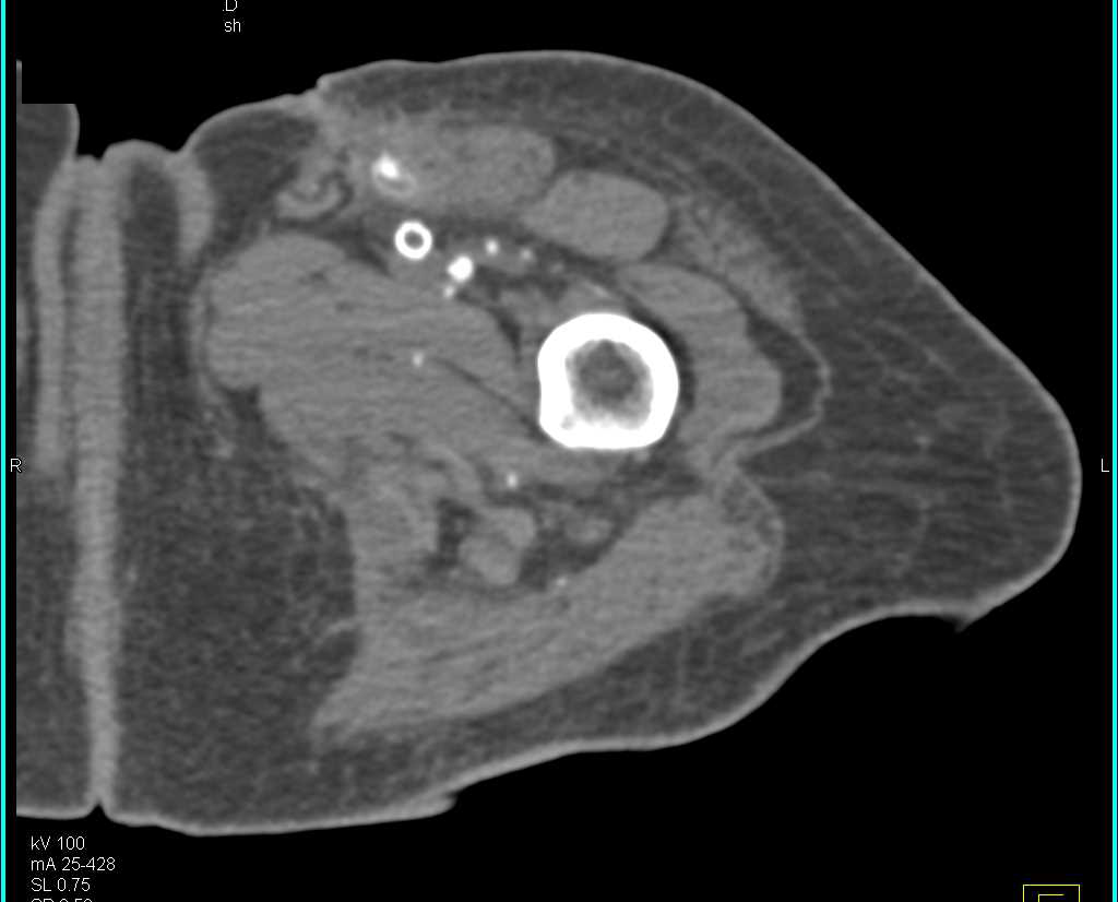 Vascular Grafts That are Patent and Occluded - CTisus CT Scan