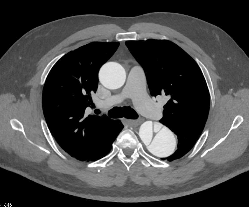 Type B Dissection with Compressed True Lumen - CTisus CT Scan