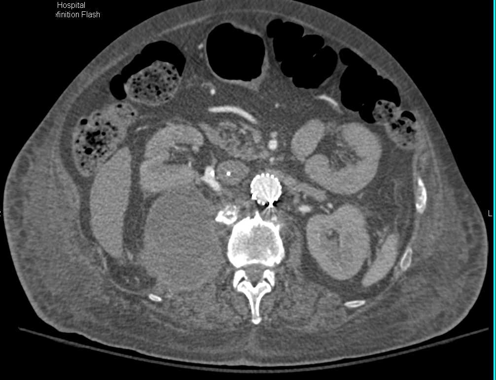 Right Psoas and Iliopsoas Bleed Post Endovascular Stenting - CTisus CT Scan