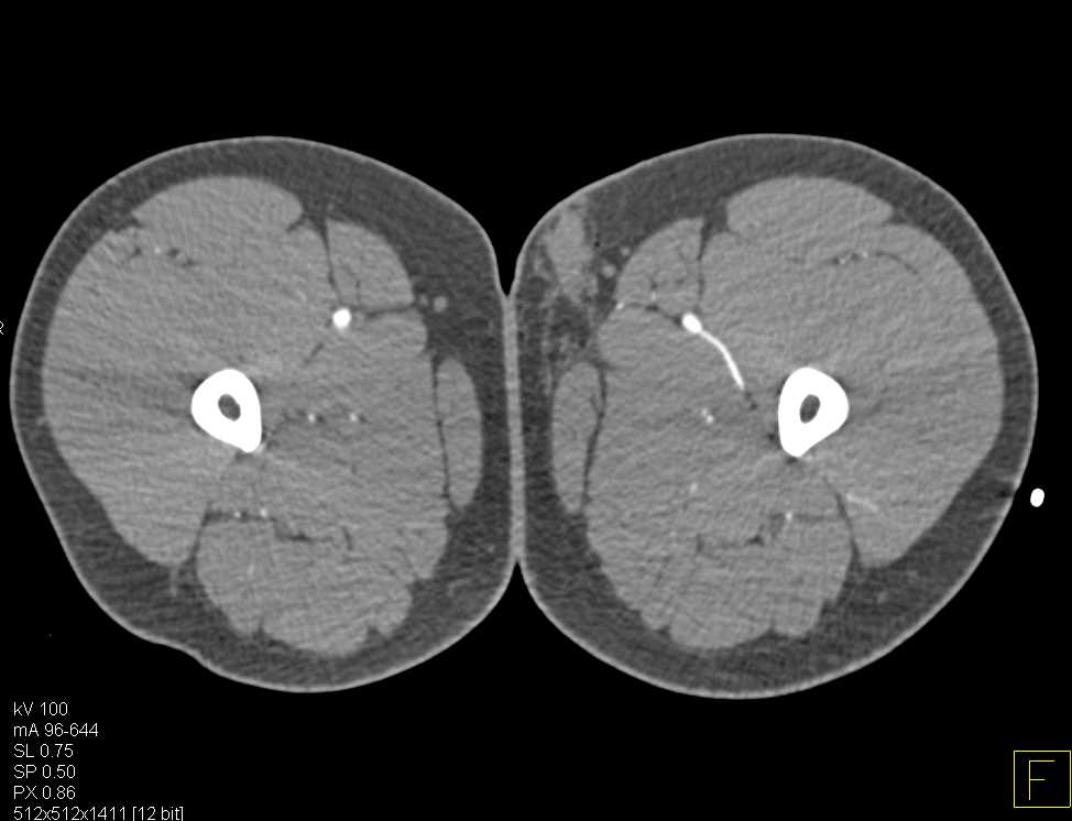 Normal CTA with Dual Energy CT and Bone Removal - Vascular Case Studies ...