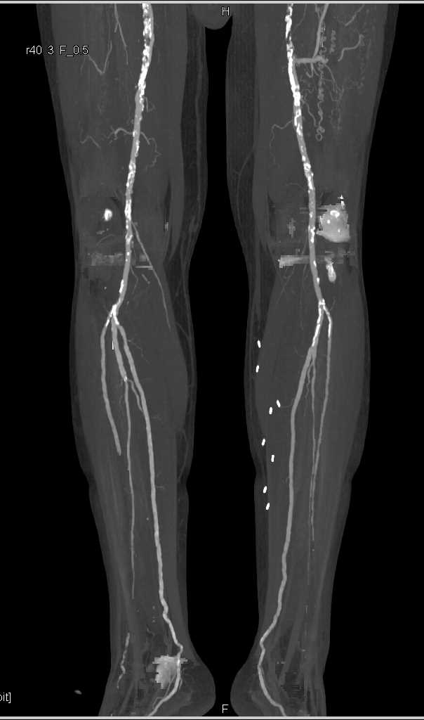 Occlusion Left Superficial Femoral Artery (SFA) with Collaterals - CTisus CT Scan