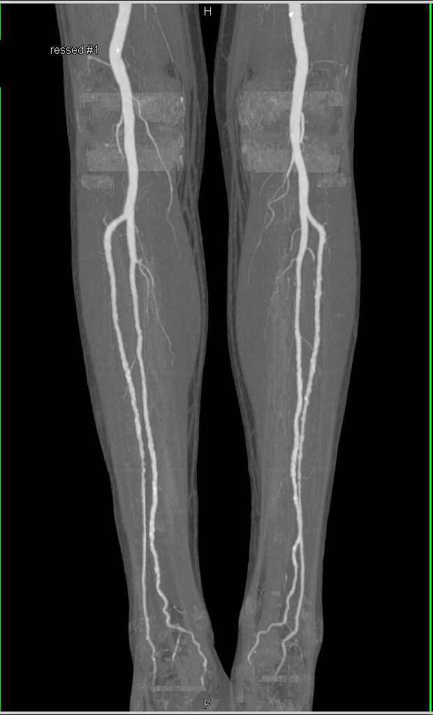 CTA Runoff with Minimal Peripheral Vascular Disease (PVD) - CTisus CT Scan