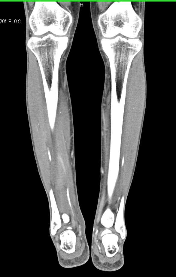 CTA Lower Extremities with Good Flow to Trifurcation Vessels - CTisus CT Scan