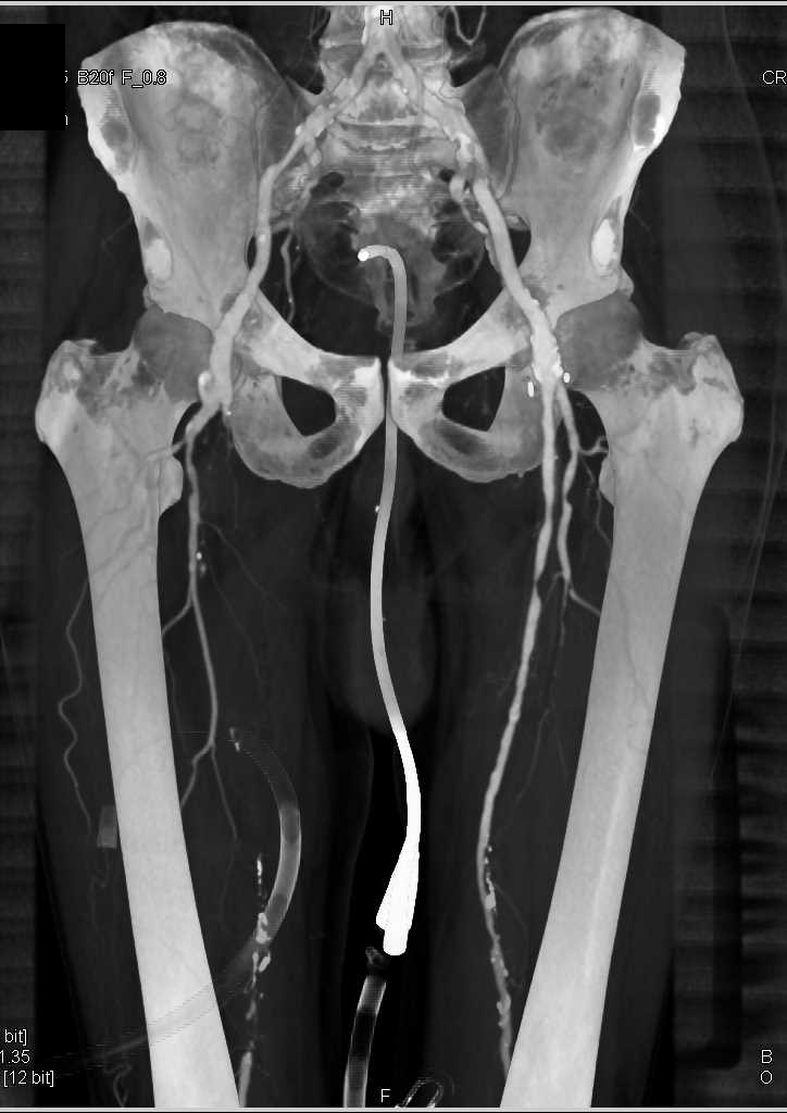 Peripheral Vascular Disease (PVD) with Occlusion of the Right Superficial Femoral Artery (SFA) - CTisus CT Scan