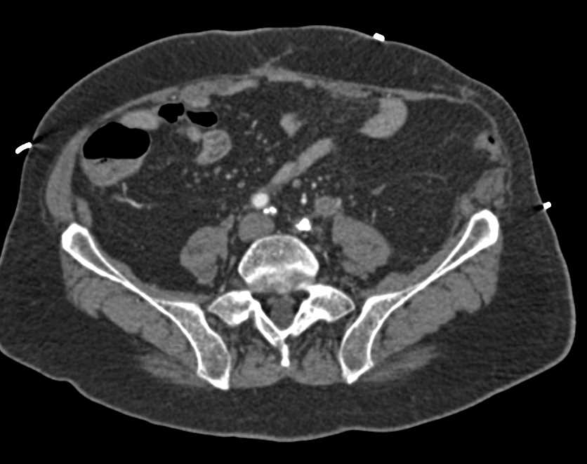 Extensive Left Sided Disease in Iliacs and Superficial Femoral Artery (SFA) due to Peripheral Vascular Disease (PVD) - CTisus CT Scan