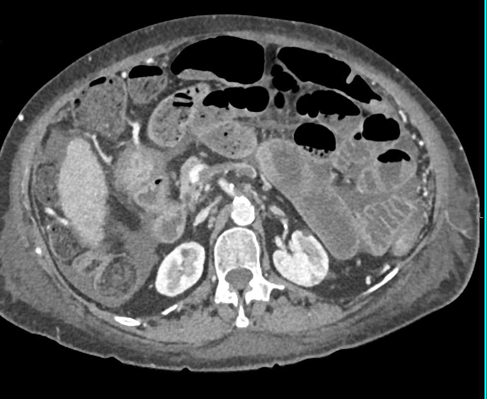 Portal Vein/Superior Mesenteric Vein (SMV) Clot with Enteritis - CTisus CT Scan