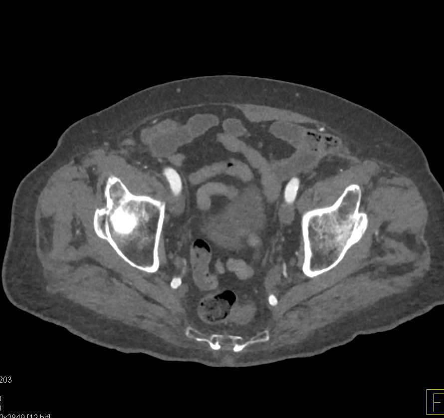 CTA Runoff with Peripheral Vascular Disease - CTisus CT Scan