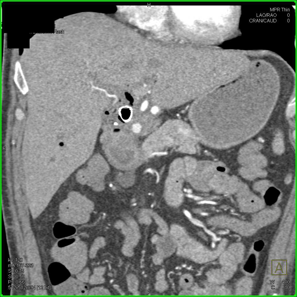 Gastroduodenal Artery (GDA) Pseudoaneurysm - CTisus CT Scan