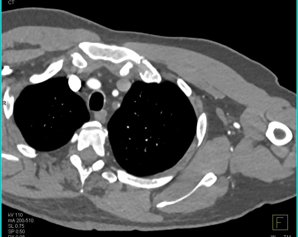 Near Occlusion By Plaque of the Left Subclavian Artery - CTisus CT Scan