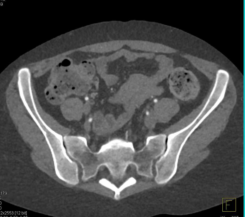 CTA Runoff with Tapering of Trifurcation Vessels Distally - CTisus CT Scan