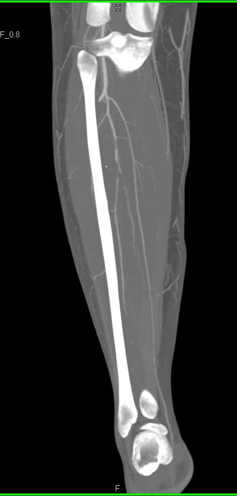 Fibular Vascular Graft Planning - CTisus CT Scan