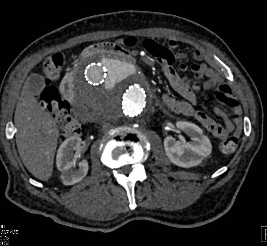 Failure Stent with Large Endoluminal Bleed - CTisus CT Scan