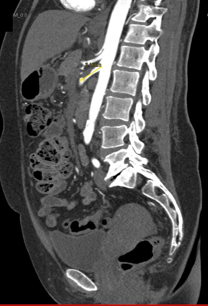 Superior Mesenteric Artery (SMA) Dissection and Aneurysm - CTisus CT Scan