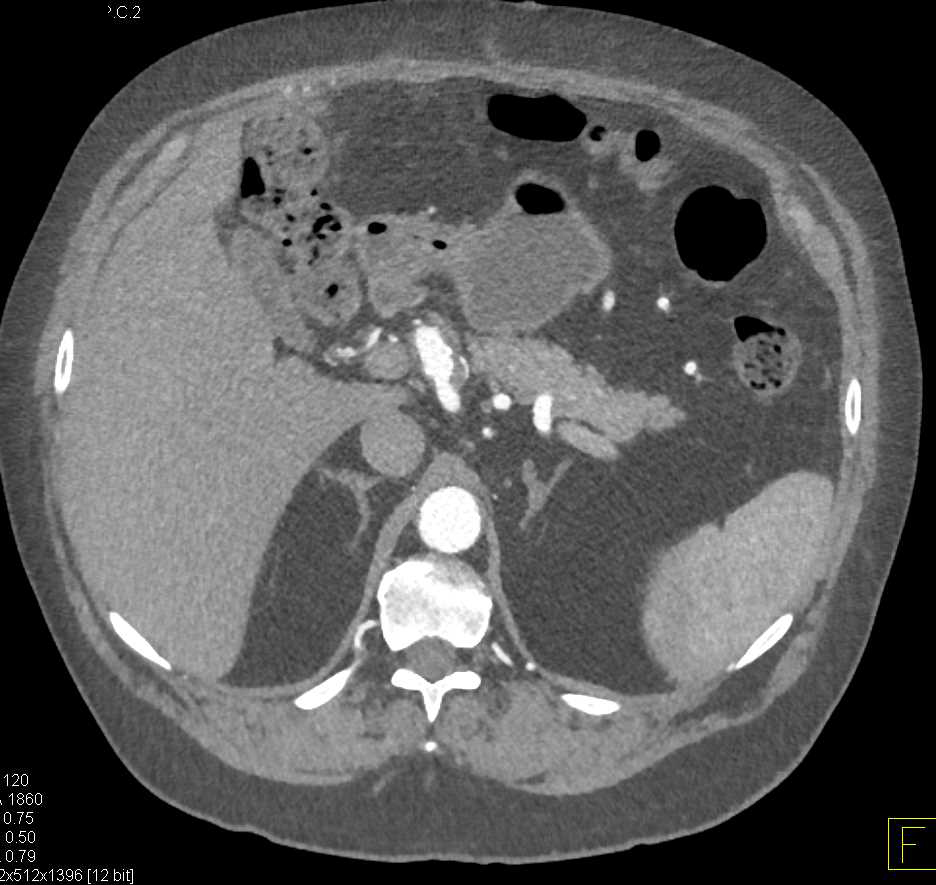 Vasculitis Involve the Branches of Celiac and Superior Mesenteric Artery (SMA) - CTisus CT Scan