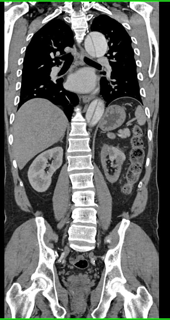 Type B Dissection with Compressed True Lumen - CTisus CT Scan