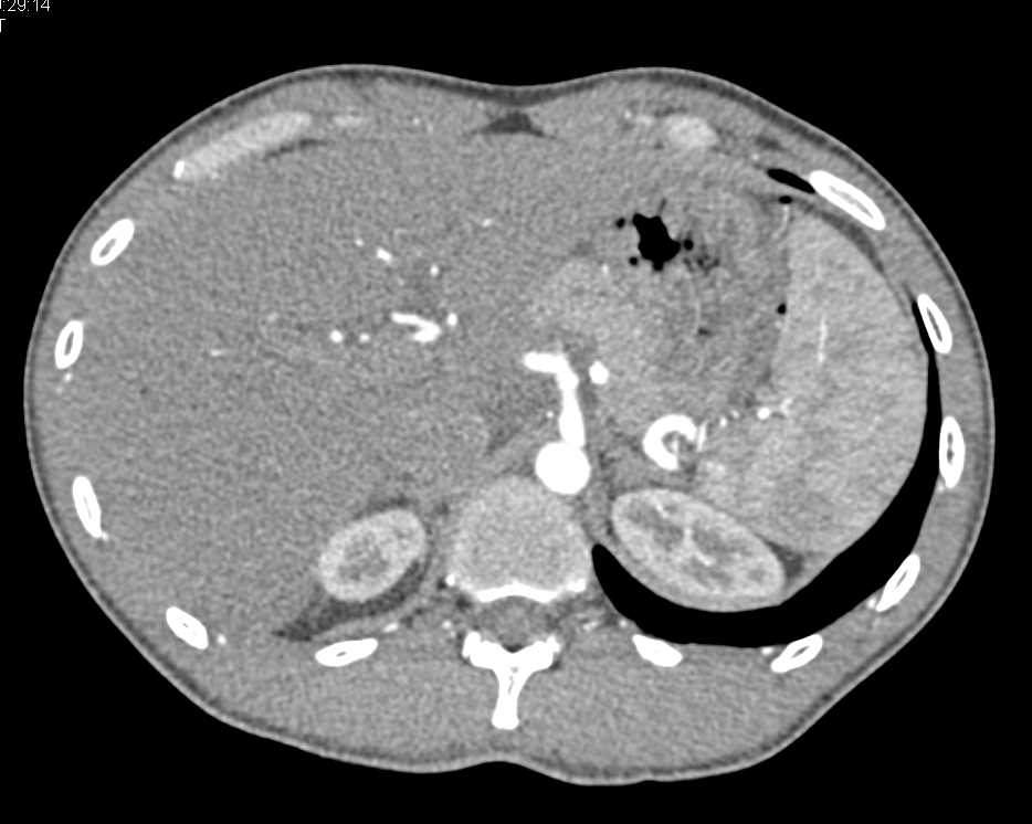 Portal Venous Air in Liver - CTisus CT Scan