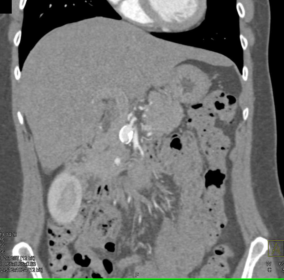 Celiac Artery Aneurysm - CTisus CT Scan