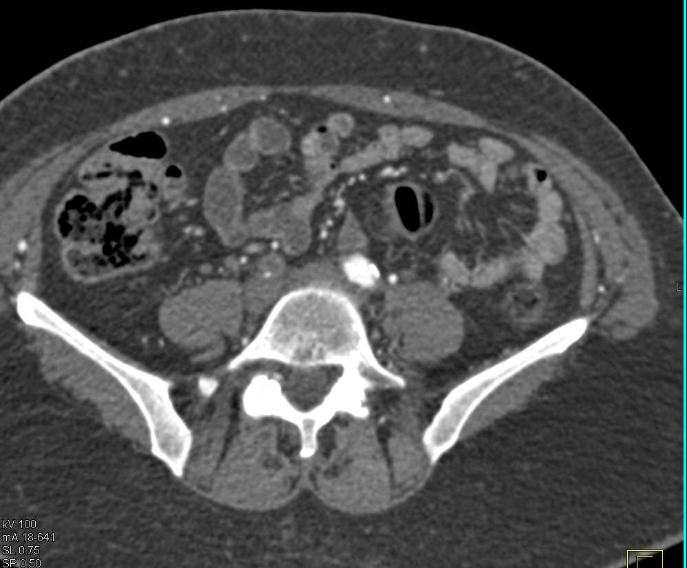 Right Common Iliac Artery Occlusion with Right Superficial Femoral Artery (SFA) Occlusion Also - CTisus CT Scan