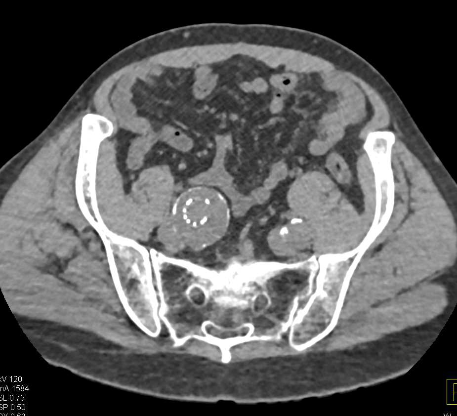 Right Common Iliac Artery Aneurysm with Stent Repair - CTisus CT Scan