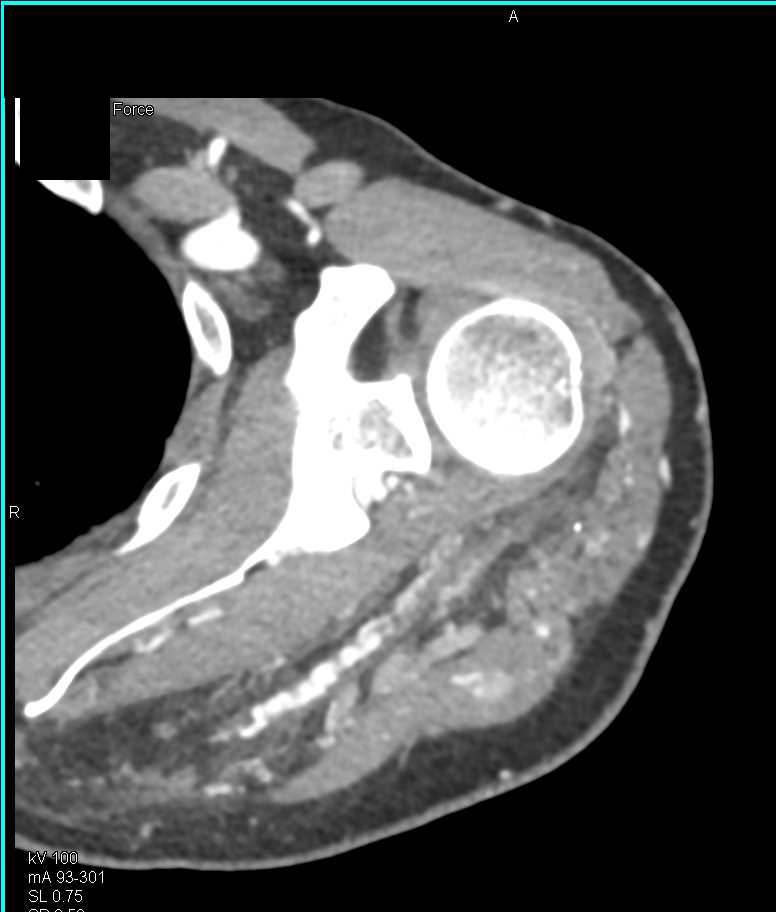 Extensive Arteriovenous Malformation (AVM) Involves Left Shoulder and Left Arm - CTisus CT Scan