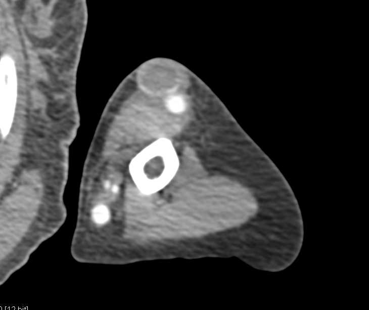 Arteriovenous (AV) Fistulae for Dialysis Left Arm - CTisus CT Scan