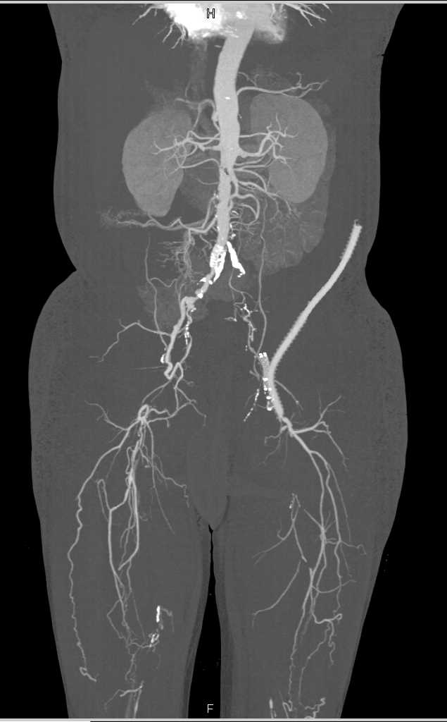 Extensive Peripheral Vascular Disease (PVD) with Occlusions and Collaterals - CTisus CT Scan