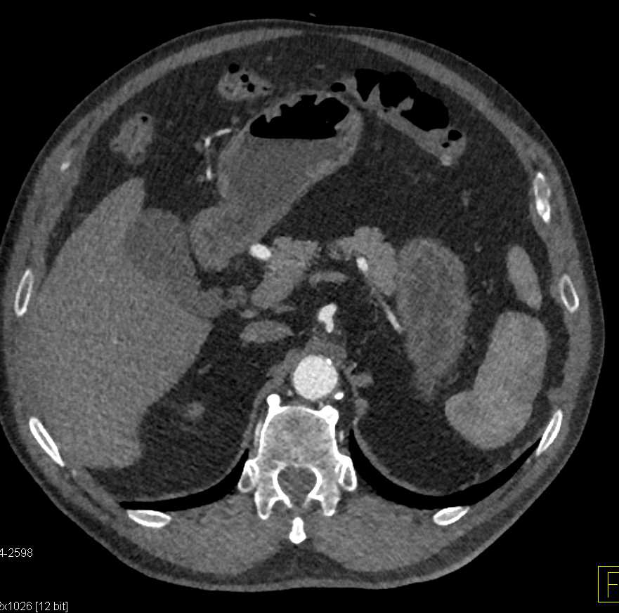 Celiac Artery Occlusion with Collaterals Thru the Gastroduodenal Artery (GDA) - CTisus CT Scan