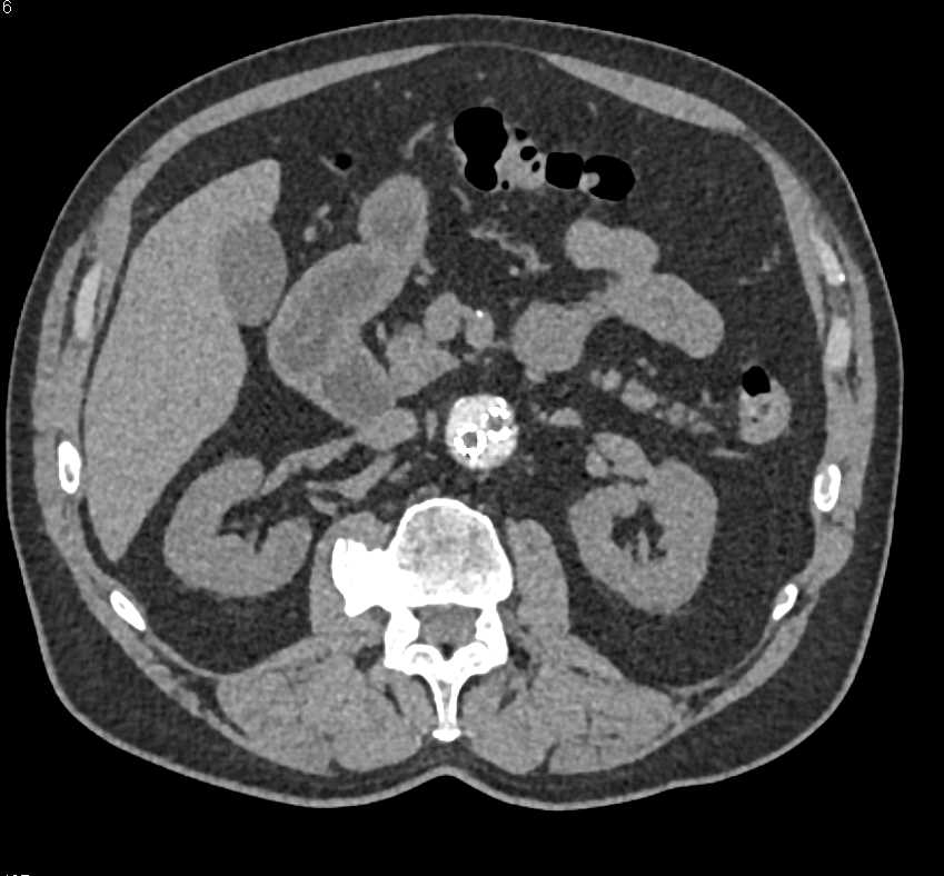 Endovascular Stent Repair with Endoleak - CTisus CT Scan