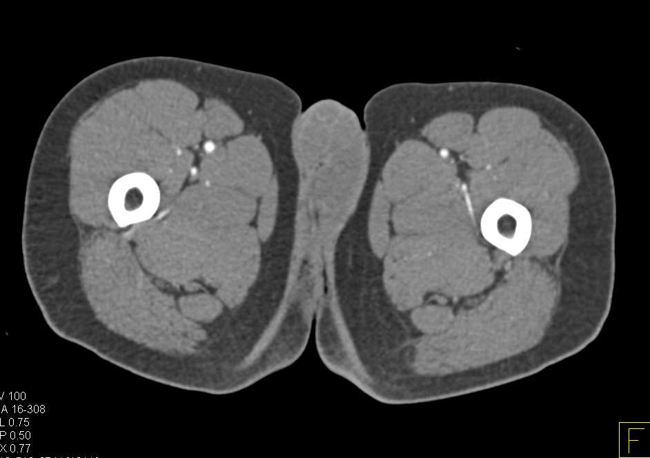 CT Runoff with Superficial Femoral Artery (SFA) Occlusion due to Thrombus - CTisus CT Scan