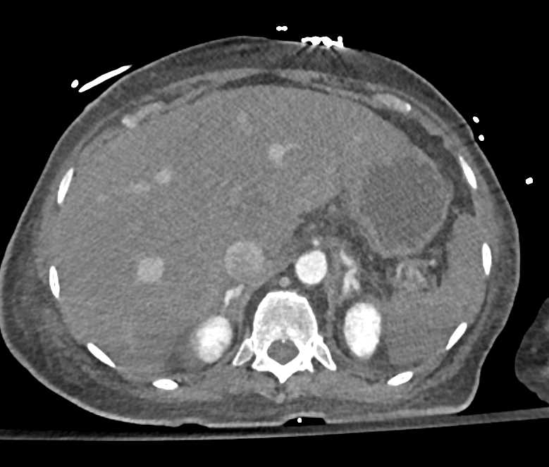 Hypotensive Patient with Bright Adrenals and Small Caliber Celiac and Superior Mesenteric Artery (SMA) - CTisus CT Scan