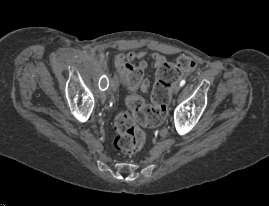 Occluded Right Iliac Artery Stent - CTisus CT Scan