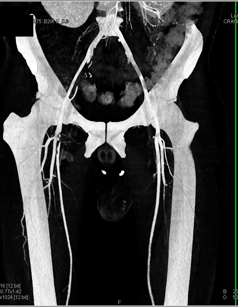 Superficial Femoral Artery (SFA) Occlusion on the Right on CTA with Bone Removal - CTisus CT Scan