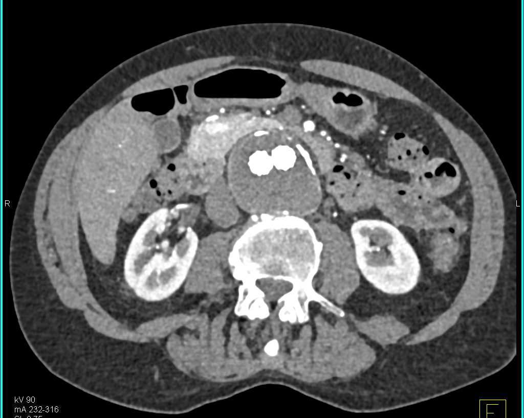 Endovascular Stent Repair - CTisus CT Scan