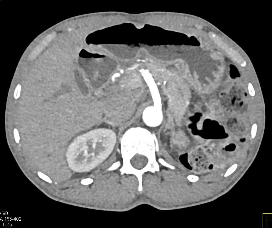 Stent in Celiac Artery is Patent - CTisus CT Scan