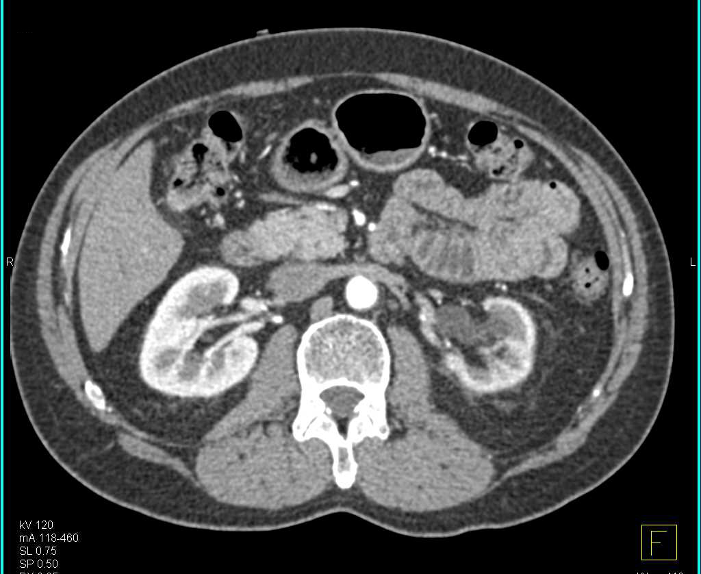 Infiltration Around the External Iliac Artery on the Left Side - CTisus CT Scan