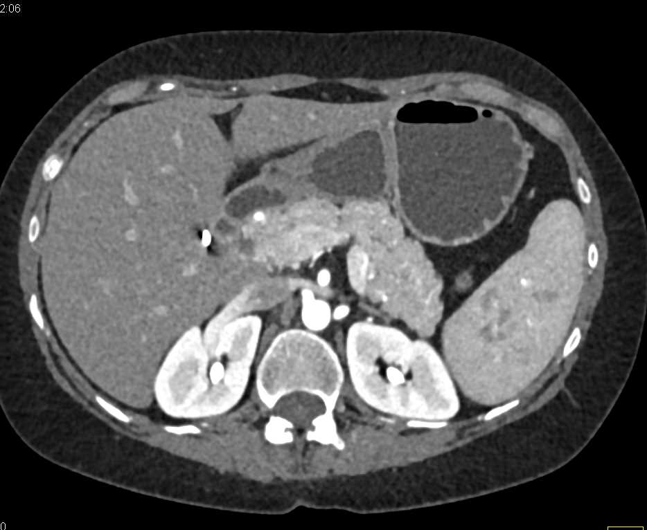 Celiac Artery Aneurysm - CTisus CT Scan