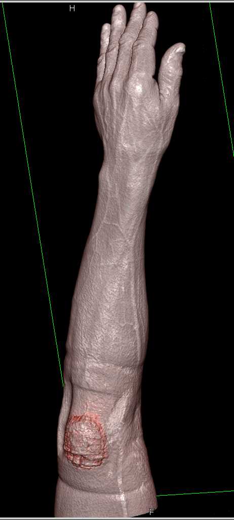 Ulnar Artery Occlusion - CTisus CT Scan