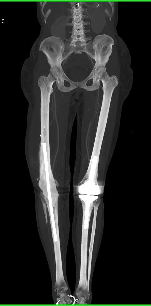 Artifacts due to Hardware Limit Vessel Evaluation - CTisus CT Scan