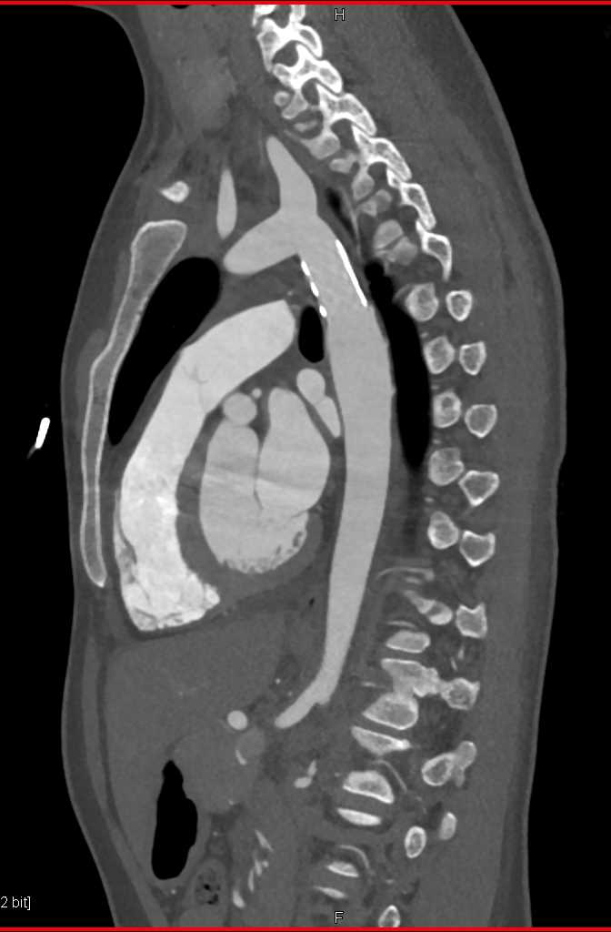 Stent Repair of Coarctation of the Aorta - CTisus CT Scan