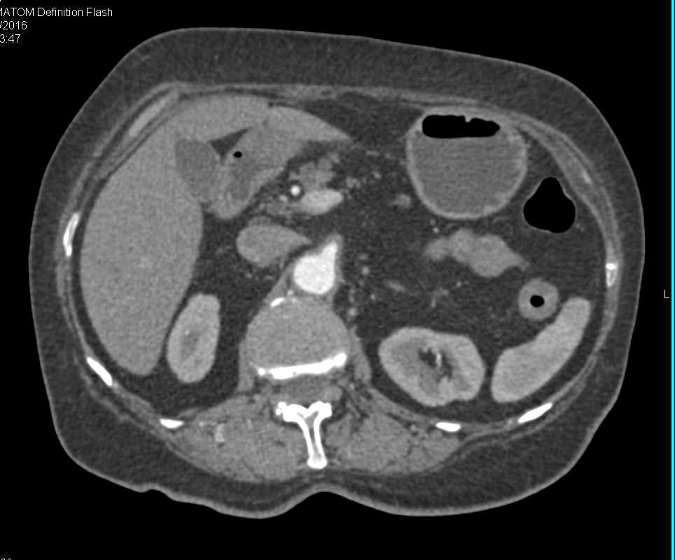 Vasculitis with Thickening Along the Superior Mesenteric Artery (SMA) - CTisus CT Scan