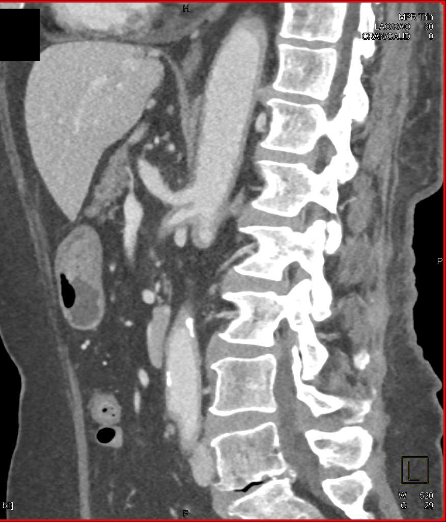 Vasculitis with Thickening Best Seen Around the Superior Mesenteric Artery (SMA) - CTisus CT Scan