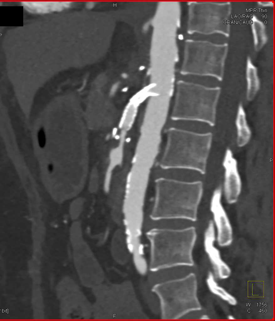 Stent in Superior Mesenteric Artery (SMA) with Focal Aneurysm - CTisus CT Scan