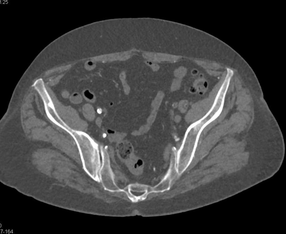 CTA with External Iliac Artery Occlusion on the Left - CTisus CT Scan