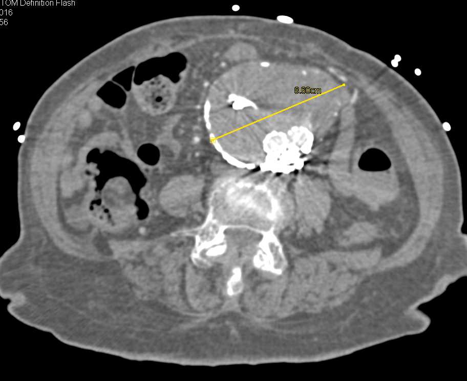 Type II Endoleak Post Endovascular Stent Repair - CTisus CT Scan